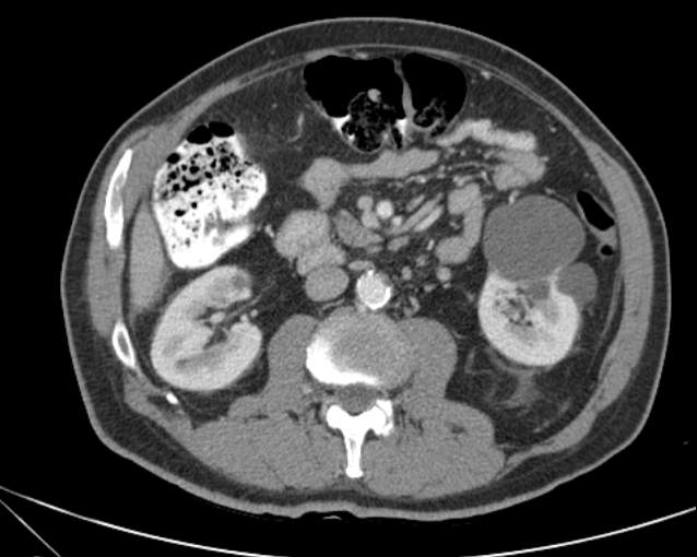 Cholecystitis - perforated gallbladder (Radiopaedia 57038-63916 A 41).jpg