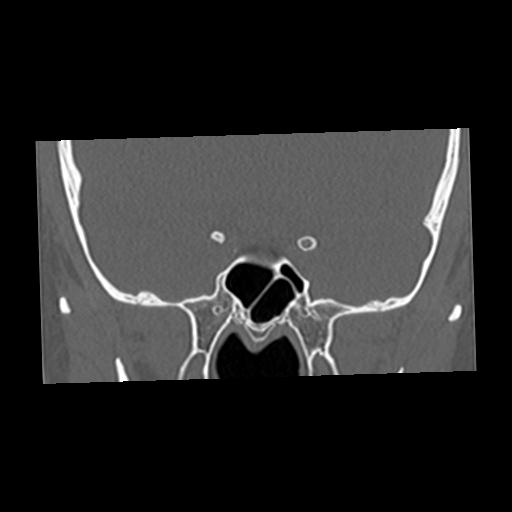 Cholesteatoma (Radiopaedia 84960-100474 Coronal bone window 3).jpg