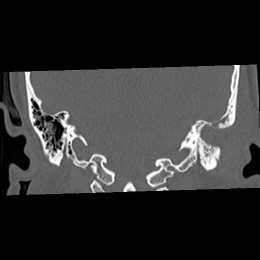 File:Cholesteatoma (Radiopaedia 84960-100474 Coronal bone window 42).jpg