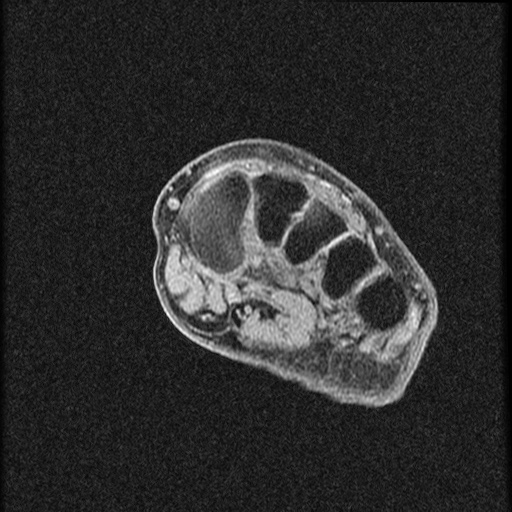 File:Chondroblastoma - midfoot (Radiopaedia 64831-73765 F 18).jpg