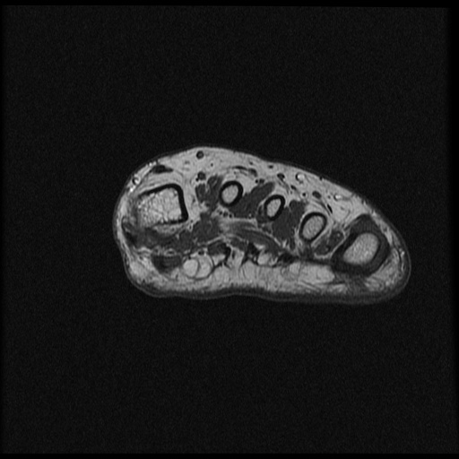 File:Chondroblastoma - midfoot (Radiopaedia 64831-73765 Short axis T1 30).jpg
