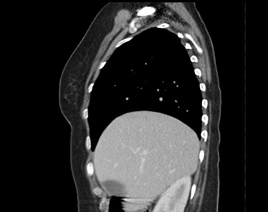 Chondrosarcoma - chest wall (Radiopaedia 65192-74199 B 45).jpg