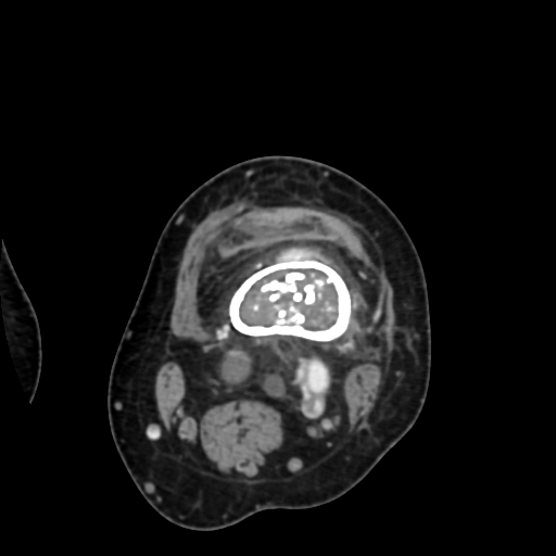 File:Chondrosarcoma - femur (Radiopaedia 64187-72954 Axial with contrast 28).jpg