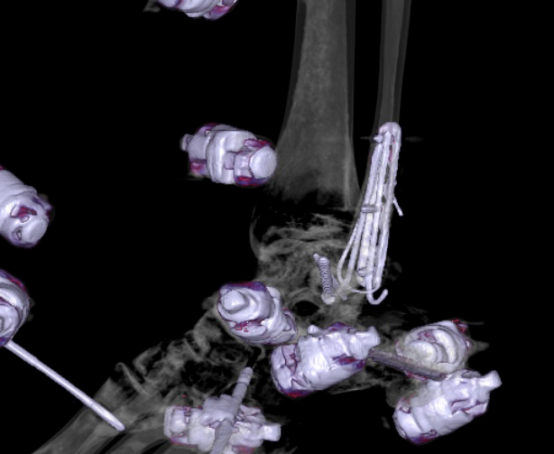 File:Chopart fracture (Radiopaedia 35347-36861 3D MPR bone window 8).jpg