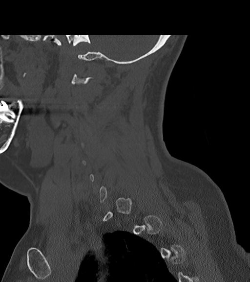 File:Chordoma (C4 vertebra) (Radiopaedia 47561-52188 Sagittal bone window 20).png
