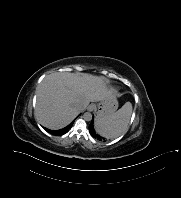 Chromophobe renal cell carcinoma (Radiopaedia 84239-99519 Axial non-contrast 33).jpg