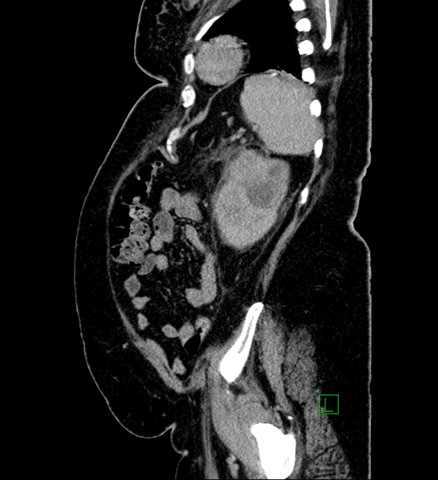 Chromophobe renal cell carcinoma (Radiopaedia 84239-99519 G 27).jpg