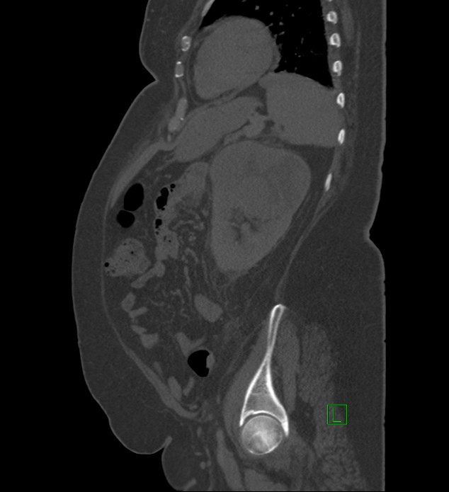 Chromophobe renal cell carcinoma (Radiopaedia 84239-99519 Sagittal bone window 27).jpg