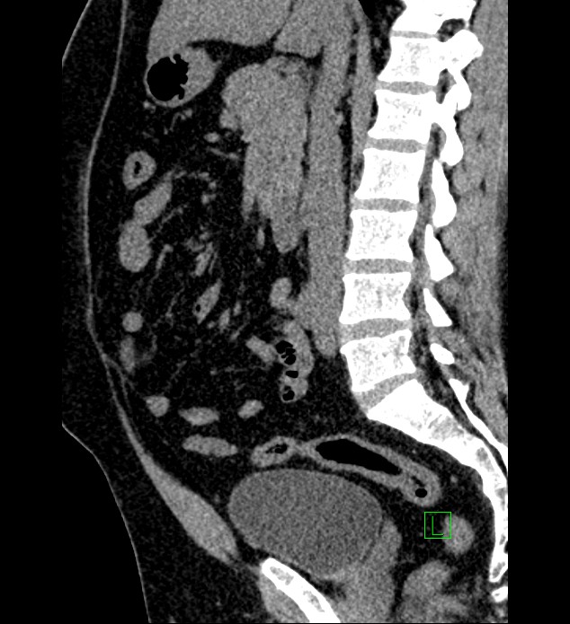 Chromophobe renal cell carcinoma (Radiopaedia 84286-99573 C 95).jpg
