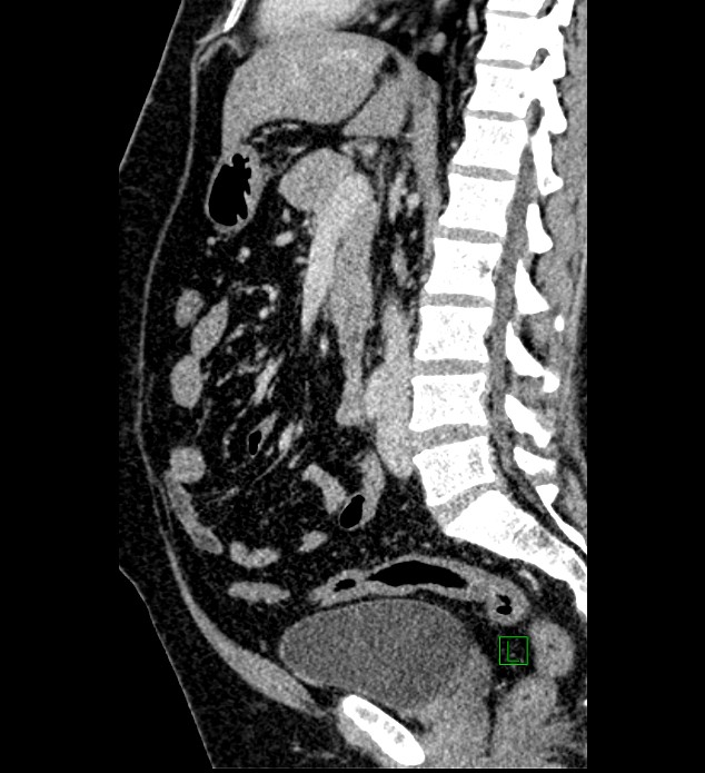 Chromophobe renal cell carcinoma (Radiopaedia 84286-99573 I 93).jpg
