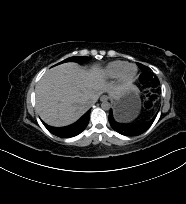 Chromophobe renal cell carcinoma (Radiopaedia 84290-99582 Axial non-contrast 20).jpg