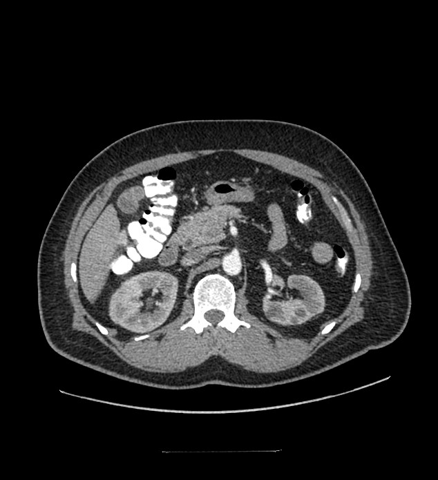 Chromophobe renal cell carcinoma (Radiopaedia 84337-99644 B 36).jpg
