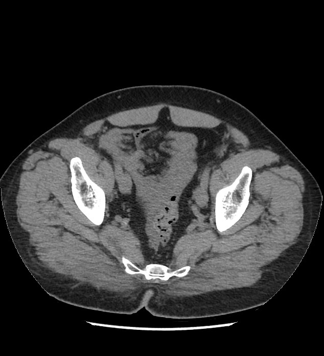 Chromophobe renal cell carcinoma (Radiopaedia 86879-103083 Axial non-contrast 111).jpg