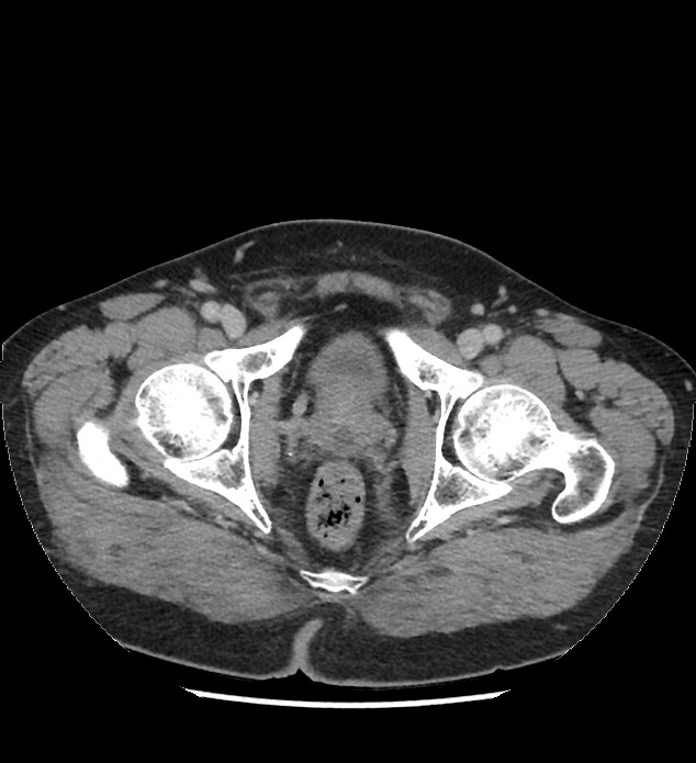 Chromophobe renal cell carcinoma (Radiopaedia 86879-103083 C 148).jpg