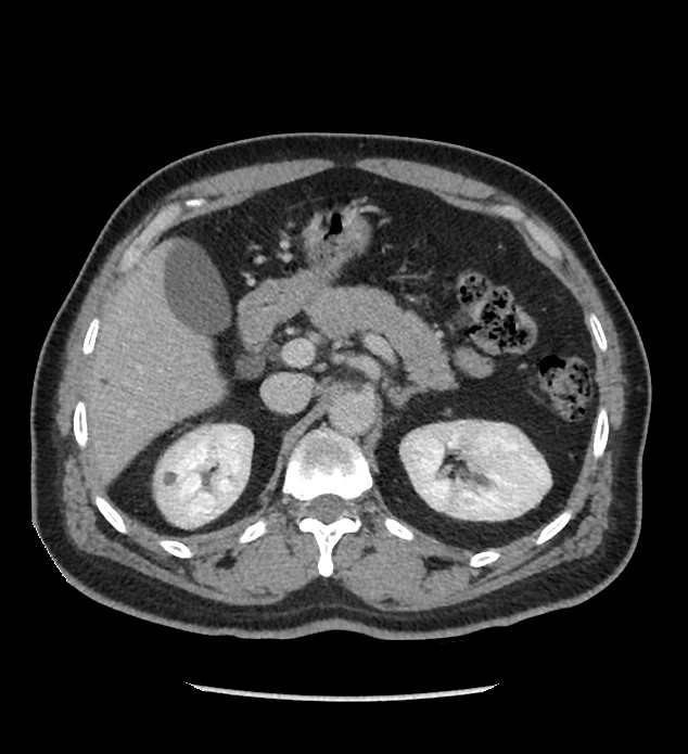 Chromophobe renal cell carcinoma (Radiopaedia 86879-103083 C 44).jpg