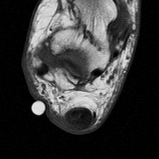 File:Chronic Achilles tendon rupture (Radiopaedia 15262-15100 Axial T1 18).jpg