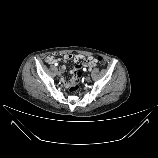 File:Chronic contained rupture of abdominal aortic aneurysm with extensive erosion of the vertebral bodies (Radiopaedia 55450-61901 A 63).jpg
