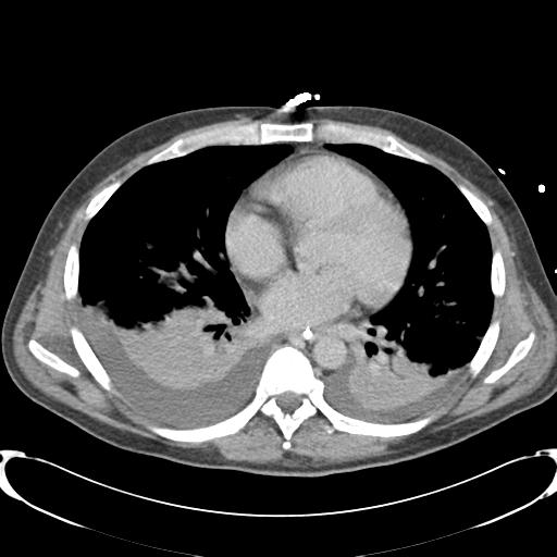 Chronic diverticulitis complicated by hepatic abscess and portal vein thrombosis (Radiopaedia 30301-30938 A 1).jpg