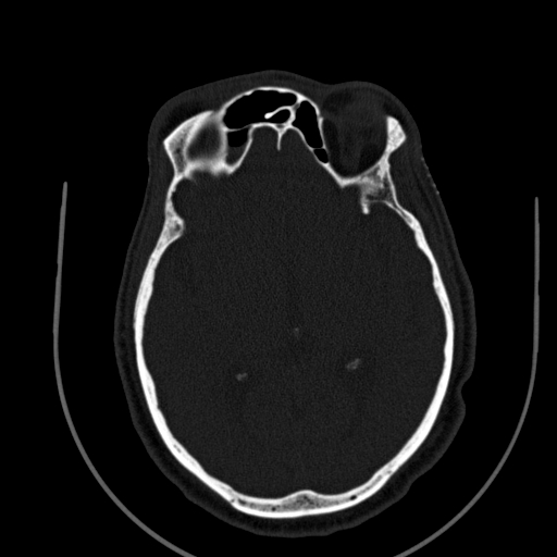 Chronic invasive fungal sinusitis (Radiopaedia 91563-109286 Axial sinus 121).jpg