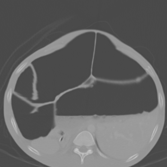 Chronic large bowel pseudo-obstruction (Radiopaedia 43181-46492 Axial bone window 53).jpg