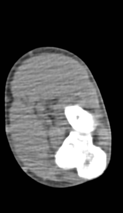 Chronic osteomyelitis of the distal humerus (Radiopaedia 78351-90971 Axial non-contrast 103).jpg
