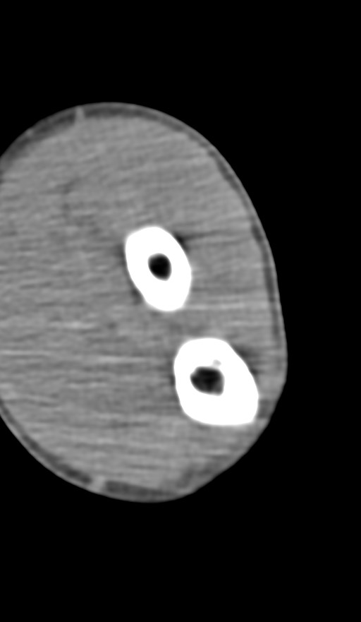 Chronic osteomyelitis of the distal humerus (Radiopaedia 78351-90971 Axial non-contrast 115).jpg