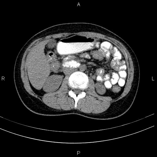 Chronic pancreatitis (Radiopaedia 64576-73450 Axial non-contrast 71).jpg