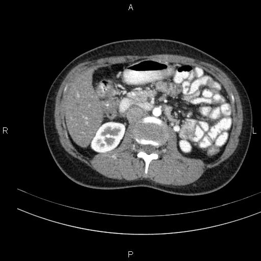 Chronic pancreatitis (Radiopaedia 64576-73450 B 73).jpg