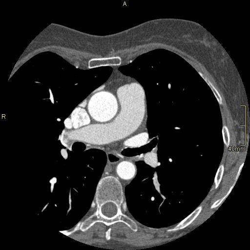 Chronic pulmonary embolism (Radiopaedia 73073-85094 Axial C+ CTPA 67).jpg