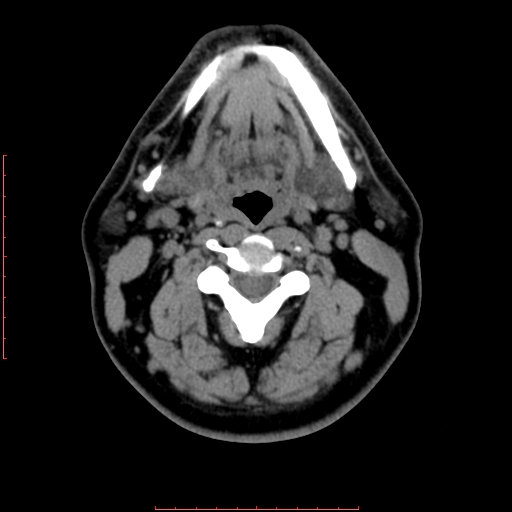 Chronic submandibular sialolithiasis (Radiopaedia 69817-79814 Axial non-contrast 113).jpg