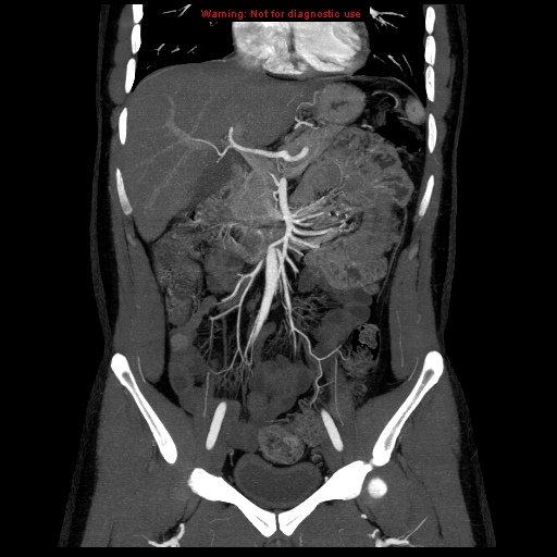 File:Circumaortic left renal vein (Radiopaedia 9069-9792 B 11).jpg
