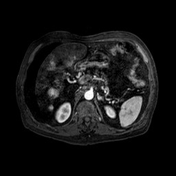 Cirrhosis and hepatocellular carcinoma in the setting of hemochromatosis (Radiopaedia 75394-86594 Axial T1 C+ fat sat 125).jpg