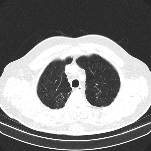 Classic complicated silicosis (Radiopaedia 49720-54961 Axial lung window 10).jpg