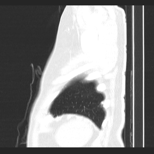 File:Classic complicated silicosis (Radiopaedia 49720-54961 Sagittal lung window 4).jpg