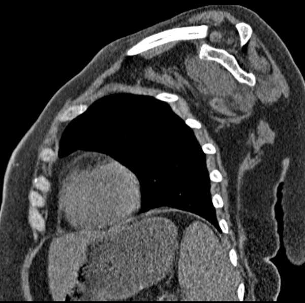 Clear cell chondrosarcoma - humerus (Radiopaedia 63104-71612 D 41).jpg