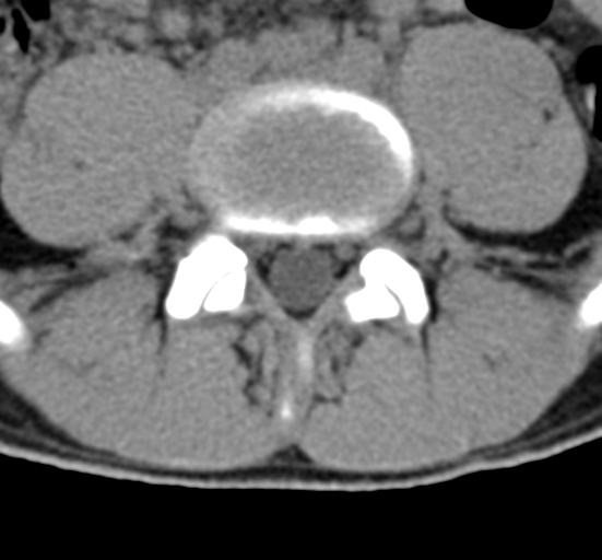 Clear cell meningoma - lumbar spine (Radiopaedia 60116-67691 Axial non-contrast 56).png