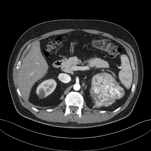 File:Clear cell renal cell carcinoma (Radiopaedia 61449-69393 B 23).jpg