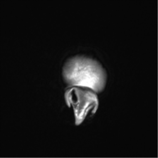 Clival chordoma invading the hypoglossal canal (Radiopaedia 48850-53887 Sagittal T1 8).png