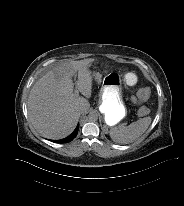 Closed-loop small bowel obstruction-internal hernia (Radiopaedia 78439-91096 Axial non-contrast 33).jpg