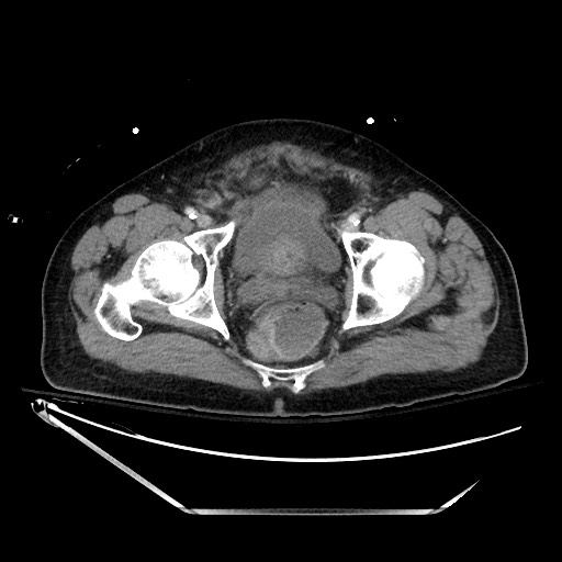File:Closed loop obstruction due to adhesive band, resulting in small bowel ischemia and resection (Radiopaedia 83835-99023 D 144).jpg