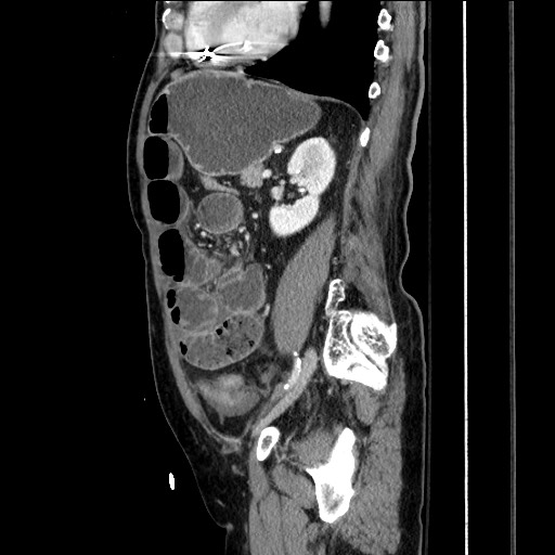 Closed loop obstruction due to adhesive band, resulting in small bowel ischemia and resection (Radiopaedia 83835-99023 F 120).jpg