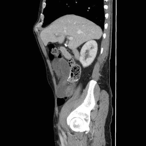Closed loop small bowel obstruction (Radiopaedia 59227-66554 C 19).jpg