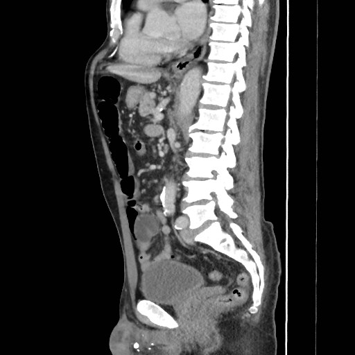 File:Closed loop small bowel obstruction (Radiopaedia 59227-66554 C 36).jpg