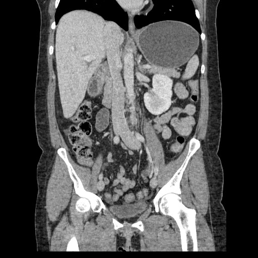 File:Closed loop small bowel obstruction (Radiopaedia 65403-74451 B 57).jpg