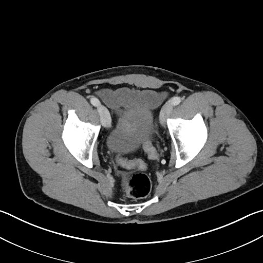 File:Closed loop small bowel obstruction - internal hernia (Radiopaedia 57806-64778 B 113).jpg