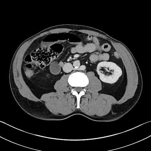 Closed loop small bowel obstruction - internal hernia (Radiopaedia 57806-64778 B 61).jpg