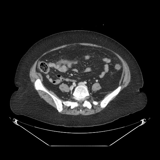 File:Closed loop small bowel obstruction - internal hernia (Radiopaedia 65402-74450 A 87).jpg