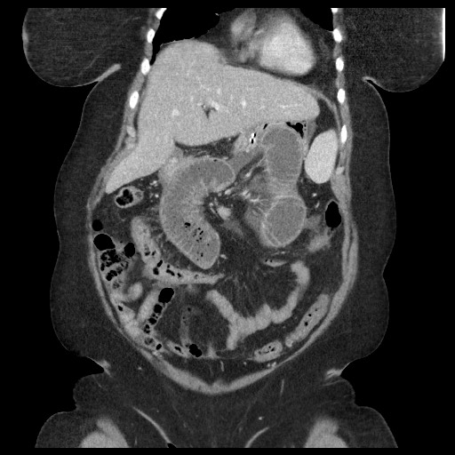 Closed loop small bowel obstruction - internal hernia (Radiopaedia 65402-74450 B 34).jpg