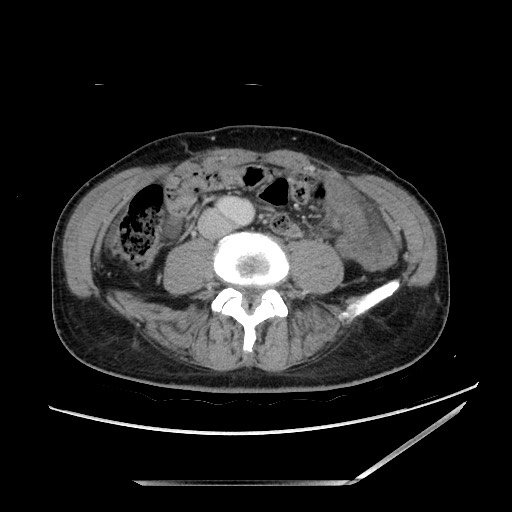 Closed loop small bowel obstruction - omental adhesion causing "internal hernia" (Radiopaedia 85129-100682 A 101).jpg