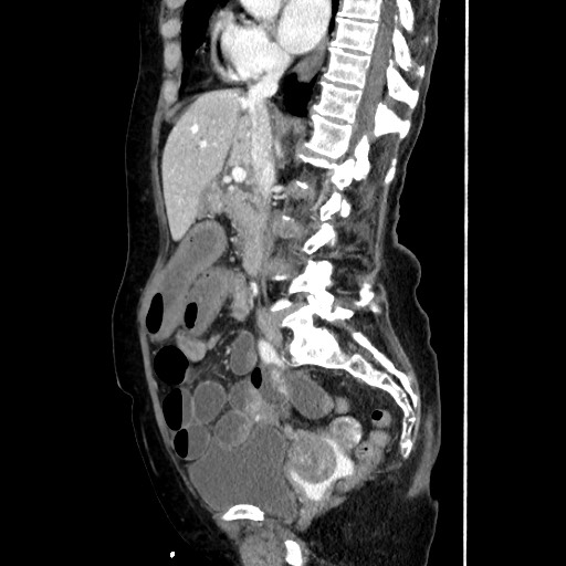 File:Closed loop small bowel obstruction due to adhesive band, with intramural hemorrhage and ischemia (Radiopaedia 83831-99017 D 95).jpg